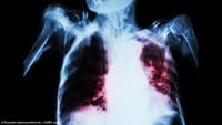 Prueba rápida para detectar la tuberculosis