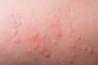 Un medicamento común contra el asma resulta eficaz contra la urticaria