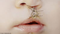 Una mutación genética causa labio leporino