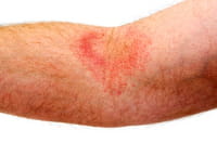 La psoriasis aumenta el riesgo de otras enfermedades