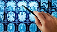 Mejor predicción del ictus cerebral