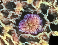 Cáncer de pulmón, ¿adiós a la 'quimio'?