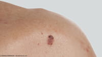 Avances en detección del cáncer de piel