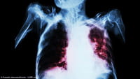 Prueba rápida para detectar la tuberculosis