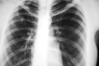 Los neumólogos alertan de dos nuevos virus que causan infecciones respiratorias