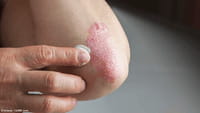 Ixekizumab aclara las placas de psoriasis