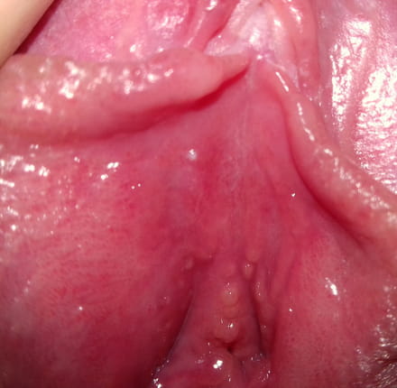 uretritis de punto rojo 2020