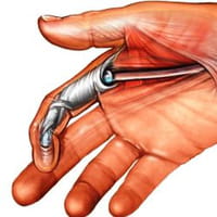 Nueva terapia no quirúrgica, probada por Atletas Profesionales para las lesiones le los tendones