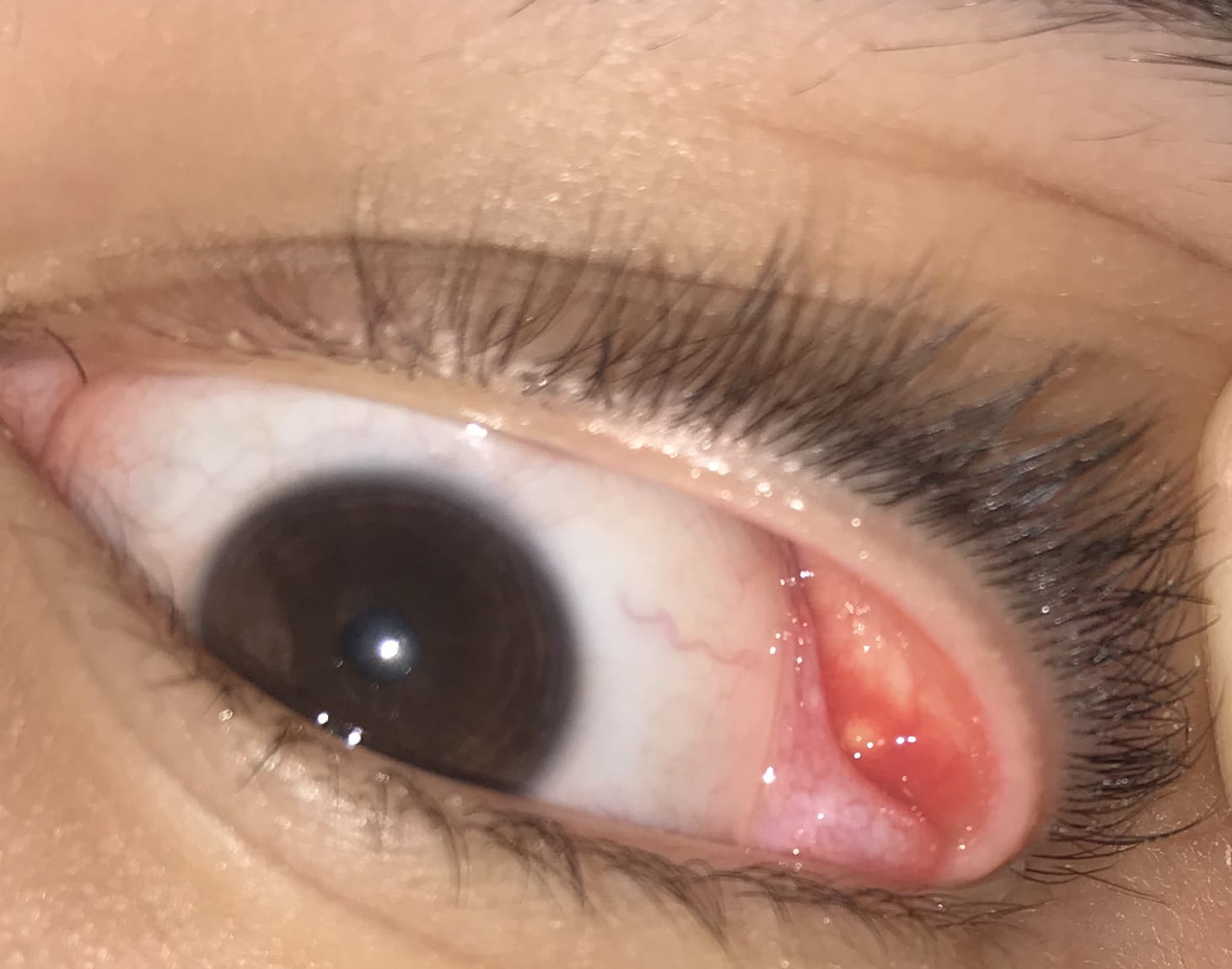 Me Salio Una Carnosidad En El Ojo