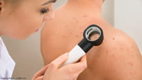 Método contra recaídas de cáncer de piel