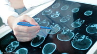 Nueva terapia contra el cáncer cerebral