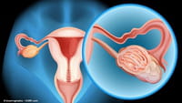 Vacuna contra el cáncer de ovarios