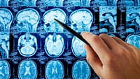 Miles de estudios del cerebro son erróneos