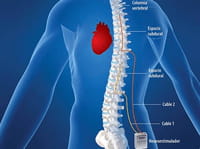 Tratan la insuficiencia cardiaca con un estimulador de espina dorsal