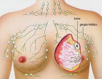 El cáncer y las enfermedades crónicas causan la mitad de las muertes en Europa