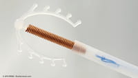 DIU contra el cáncer de cuello uterino