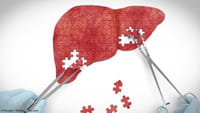 La OMS exige medidas urgentes contra la hepatitis
