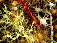 La causa de la enorme incidencia del Mal de Alzheimer entre las personas con síndrome de Down