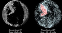 El riesgo de sufrir otro tumor aumenta un 39% tras un cáncer de mama