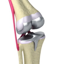La creación de una rodilla en el laboratorio