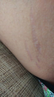 ingle testículo y dolor en las piernas