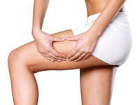 Combatir la celulitis es posible