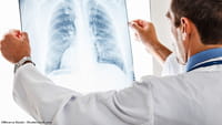 La Inteligencia Artificial contra el cáncer de pulmón