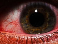 Relacionan las estatinas con un menor riesgo de glaucoma