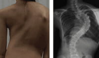 La escoliosis, una curvatura antinatural