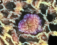 Qué hace que los hombres sean más propensos al cáncer de pulmón que las mujeres