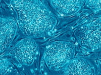Una proteína permite detectar el riesgo de recaída después de un trasplante de riñón