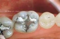 La amalgama dental no causa intoxicación por mercurio, según sentencia de la Audiencia Nacional española