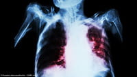 El veneno de escorpión combate la tuberculosis