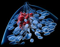 Aislamiento social y estrés triplican el riesgo de cáncer