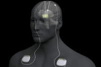 NEUROESTIMULACIÓN | Para reducir síntomas - El Parkinson, cuanto antes se opere mejor