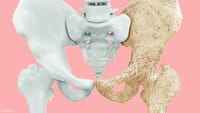 Un nuevo medicamento contra la osteoporosis