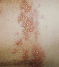 Asocian el herpes zóster con un mayor riesgo de accidente cerebrovascular en los adultos jóvenes