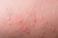 Un medicamento común contra el asma resulta eficaz contra la urticaria
