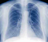 La vitamina C puede matar la tuberculosis resistente a los medicamentos