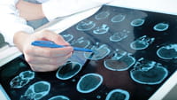 Marcapasos para tratar neuropatías