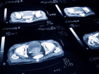 El cáncer de pulmón podría convertirse en 2015 en la primera causa de muerte por cáncer en mujeres