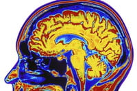 Confirman que la marihuana deteriora la capacidad cerebral, en especial en adolescentes
