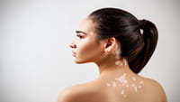 Nuevo tratamiento contra el vitiligo