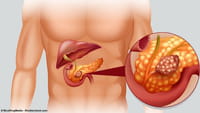 Esperanza contra el cáncer de páncreas
