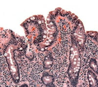 Avances en la detección de enfermedad celiaca en adultos