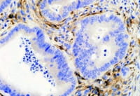 Confirman que el ADN parásito influye en la evolución del cáncer