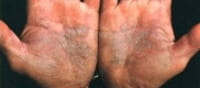 Consecuencias psicológicas de la psoriasis