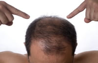 Método de regeneración capilar para inducir crecimiento de nuevo cabello en humanos