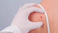 Detector de cáncer en el móvil