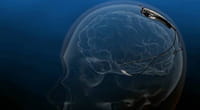 Implante pionero dispositivo de neuroestimulación activa que impide los ataques epilépticos